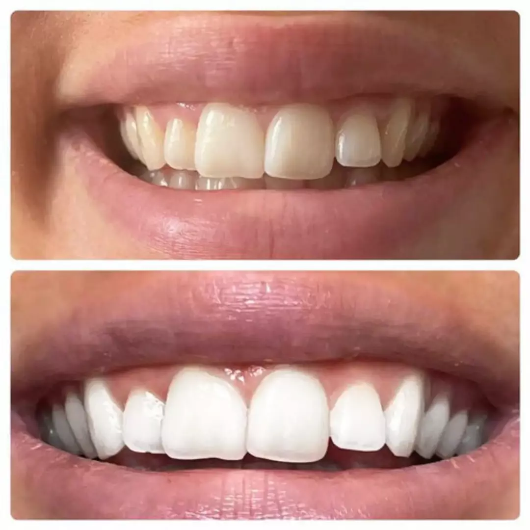 Polar MD Teeth Whitening