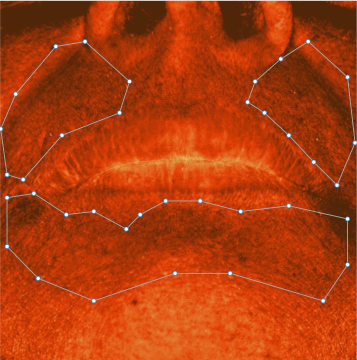 Around mouth pigmentation before using toneq