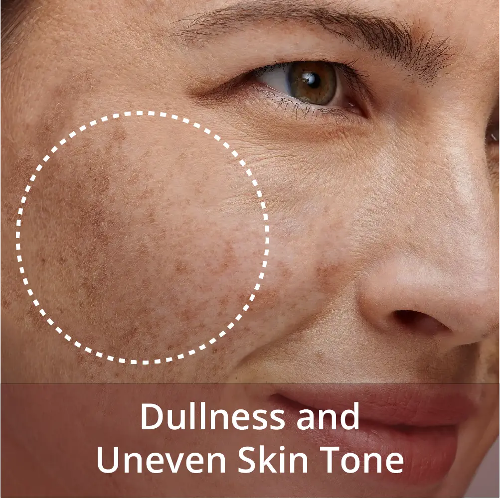 dullness and uneven skin