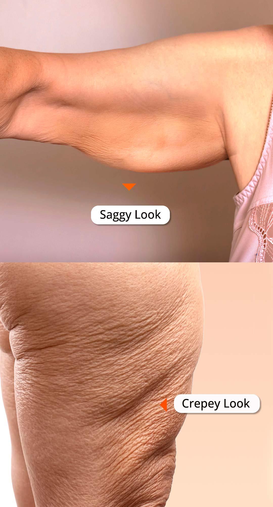 Saggy and Crepey skin