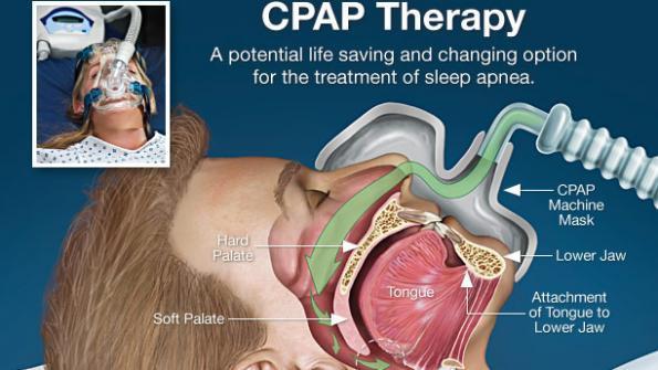 Basics About CPAP Machine And How You Can Benefit From It