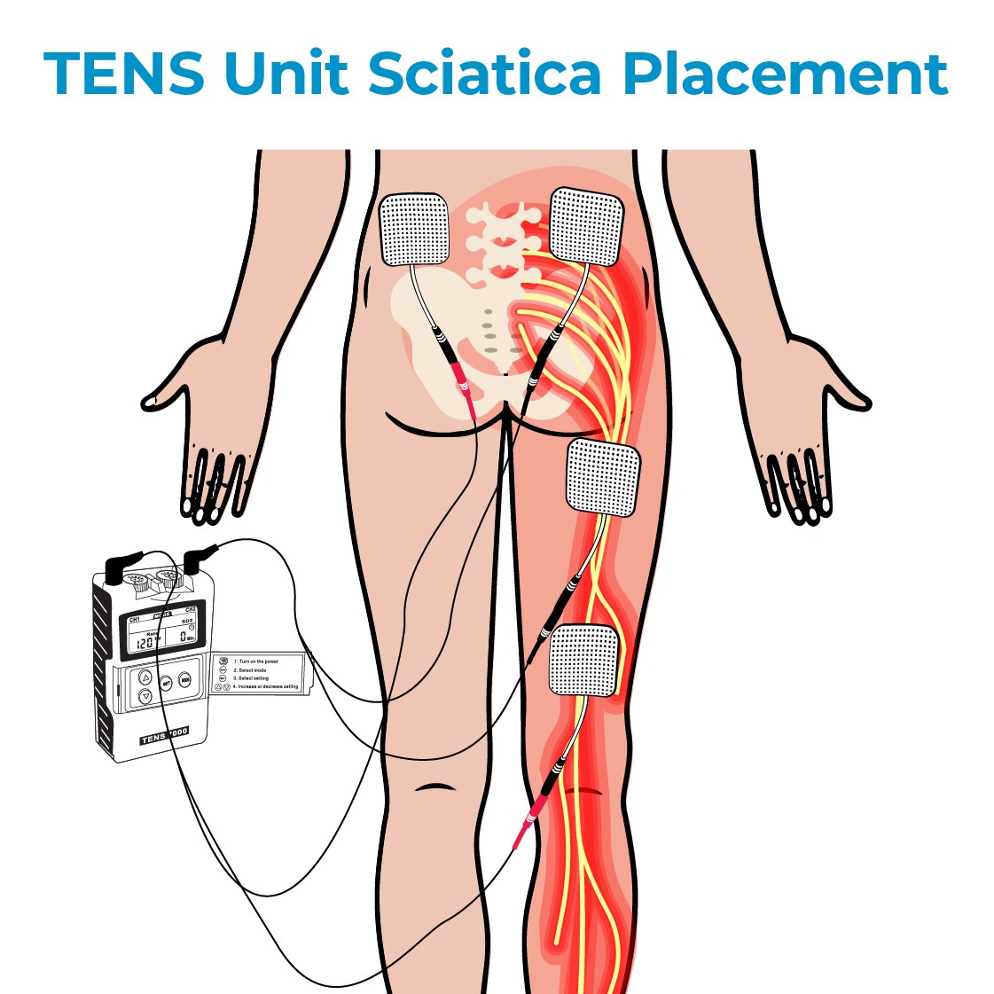 TENS Unit and Sciatica Pain Relief – TENS 7000