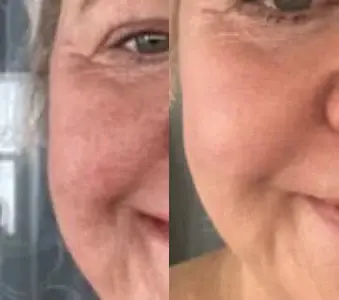 "Did More for me than Any Cosmetic Surgery I Ever Had"- Lynn L.