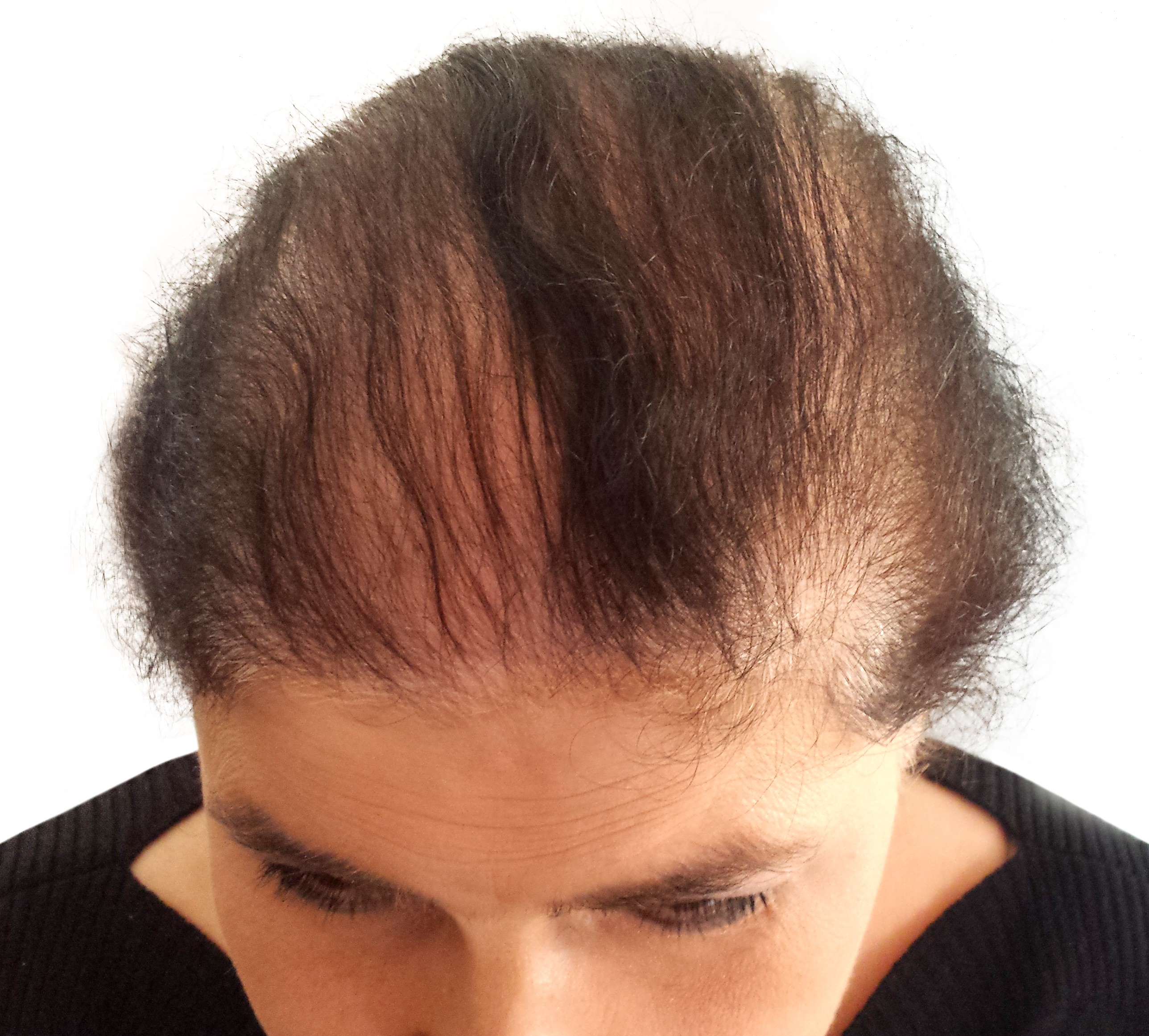 Image showing hair loss in a woman