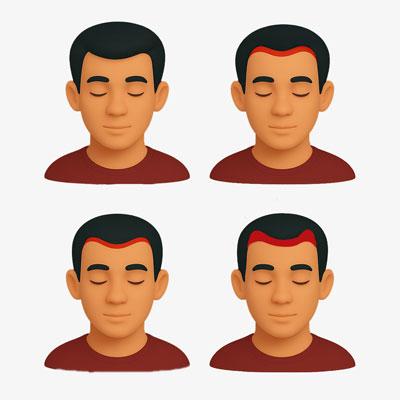 hairfall pattern in men