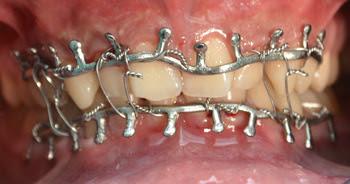 Mouth Teeth with Metal Braces Gums