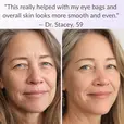 before after picture of customer with review-'this really helped with my eye bags and over skin."