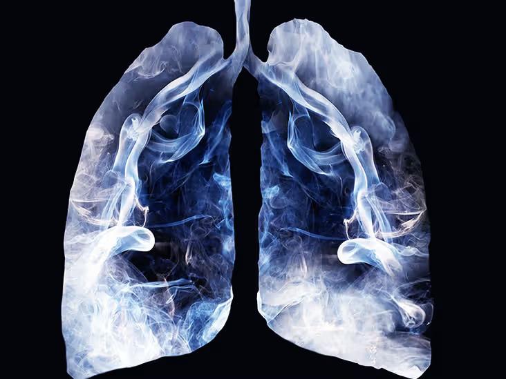 Illustration of human lungs filled with smoke, representing the potential respiratory repercussions, lung irritation, or bronchi constriction caused by inhaling rapidly cooled, moist smoke from ice-filled water pipes.