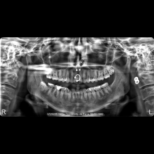 Understanding Bioplast & Piercing Retainers