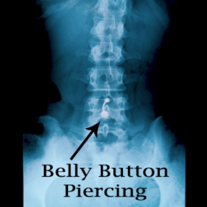 Belly Button x-ray