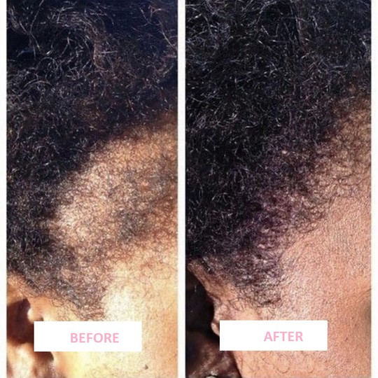 Extra Strength Hair Regrowth Serum Bundle (2oz) - Hair Spa LA