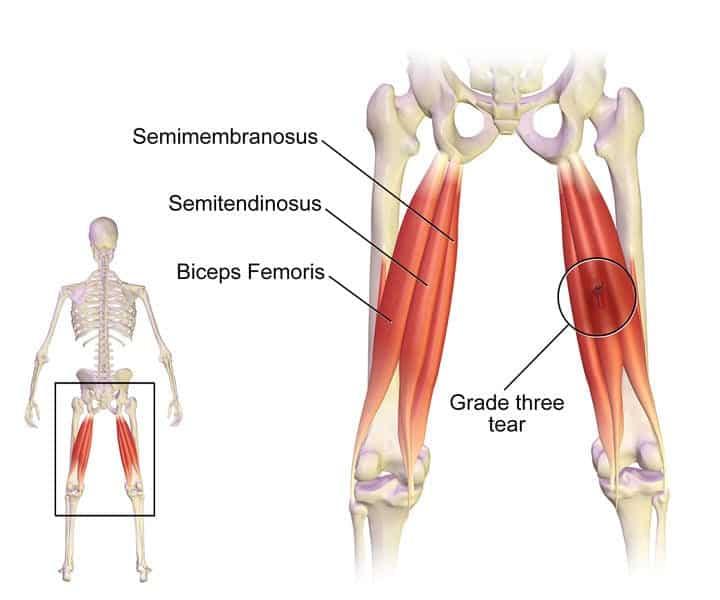 Muscle injuries eaxmple saltwrap