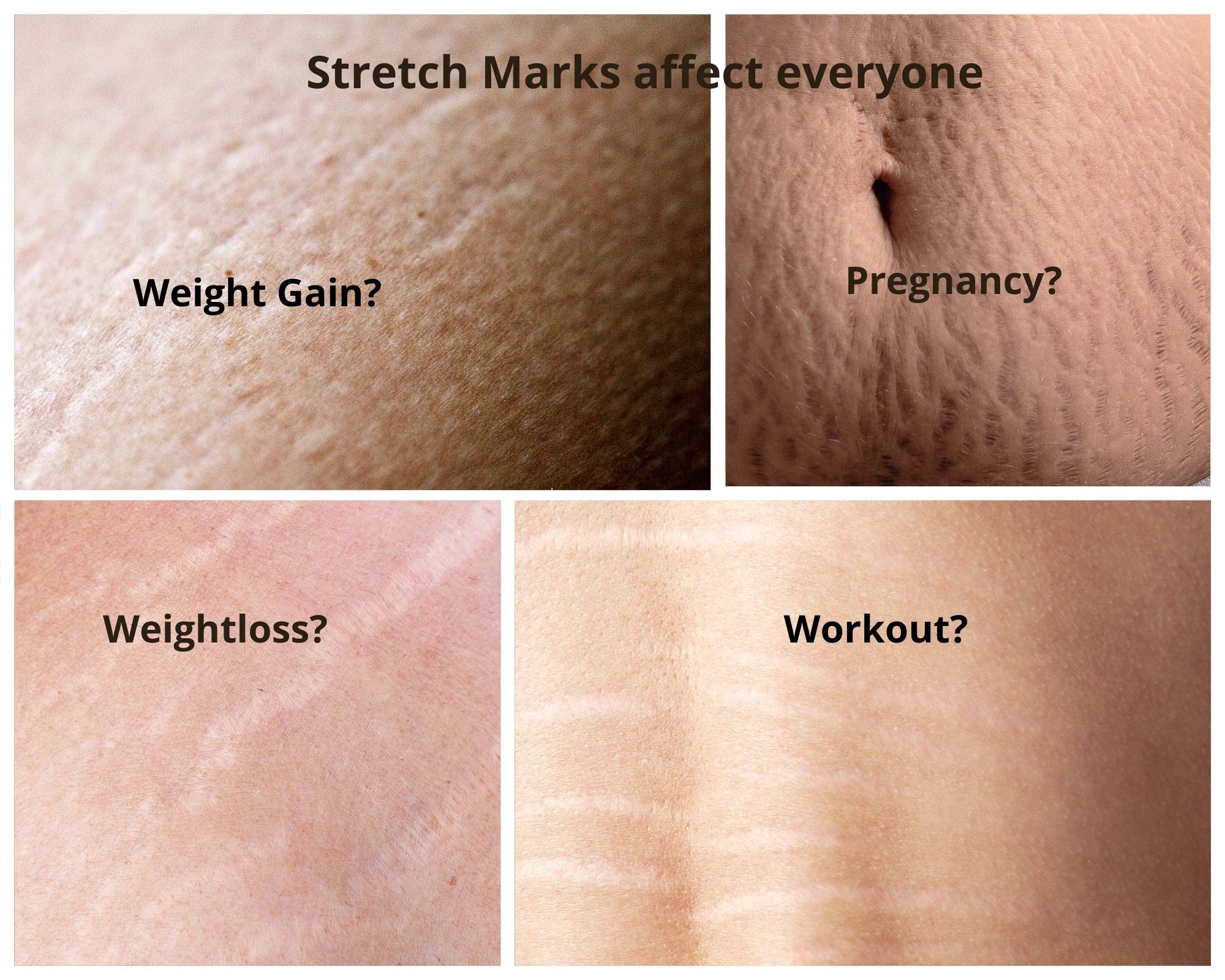 stretch mark examples