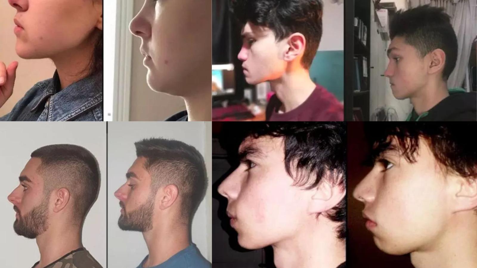 Beet mewing before and afters #fyp #mewing #jawline, Jawline