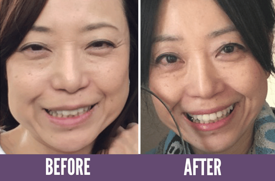 Koko Face Yoga Before/After Results