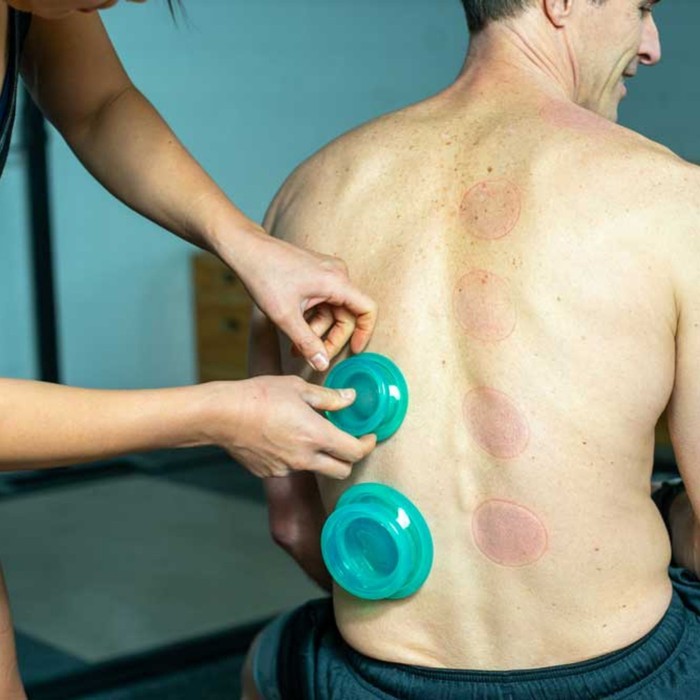 Cupping for the Neck Pain and Shoulder Tension - Lure Essentials