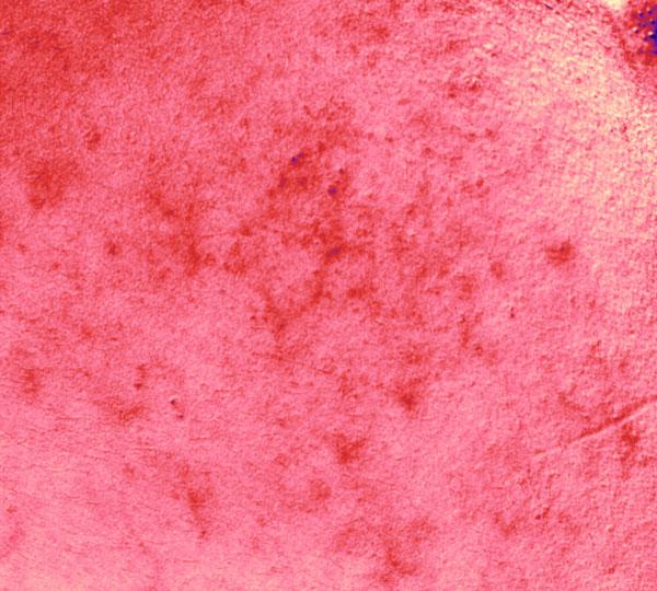 Redness reduction in participant on day 56, after 8 weeks of consistent use of Clearizy