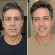 before after image of male in his 50's showing improved appearance of eye bags