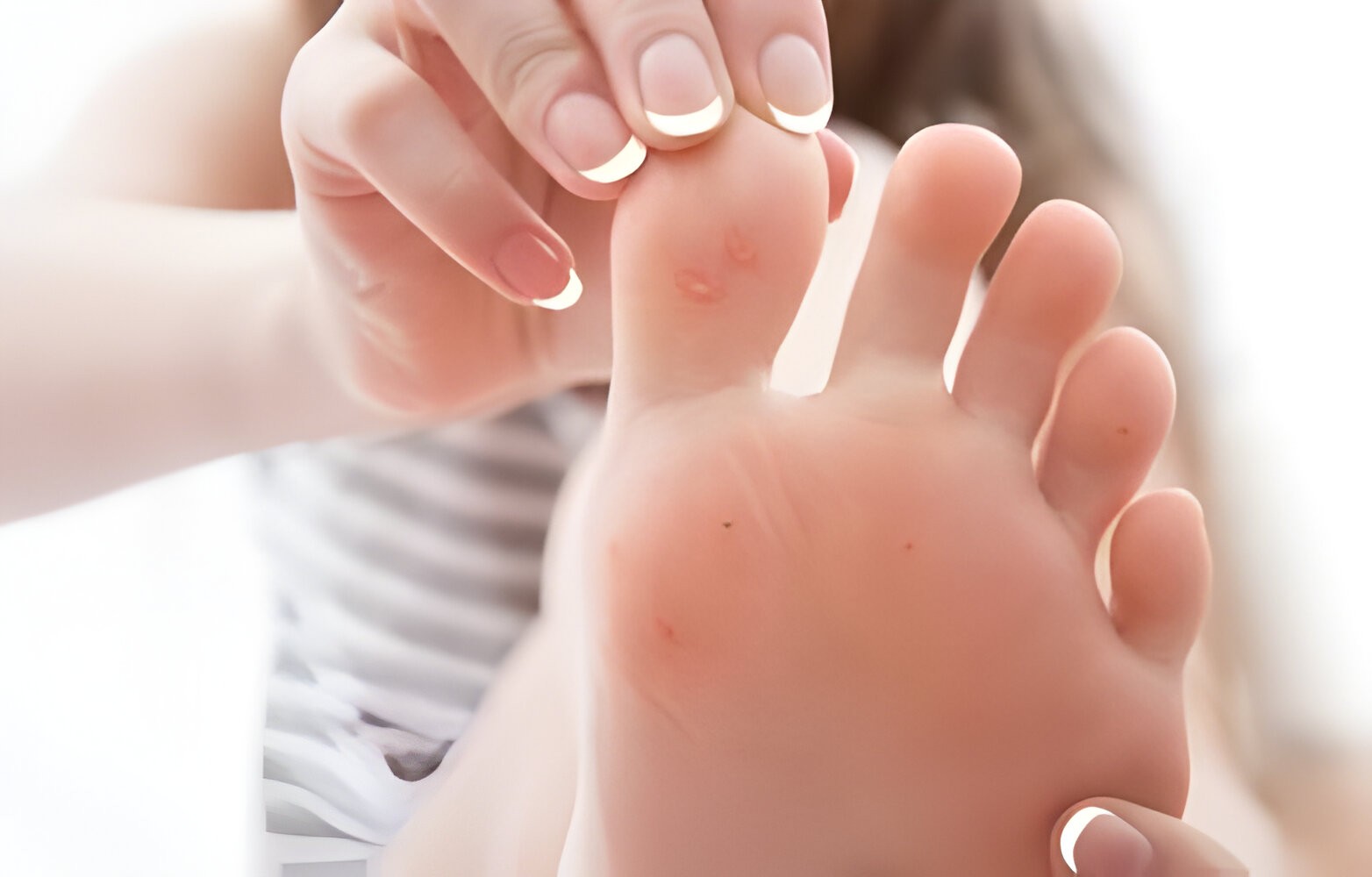 Essential Oils for Warts Removal