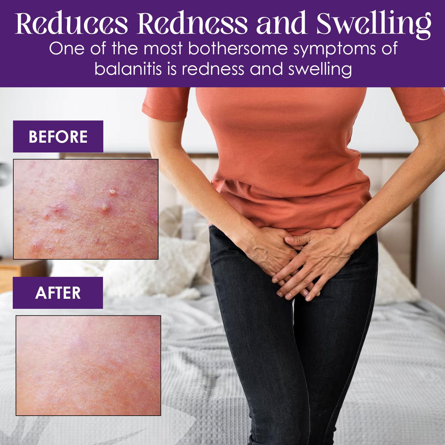 Balanitis Pictures