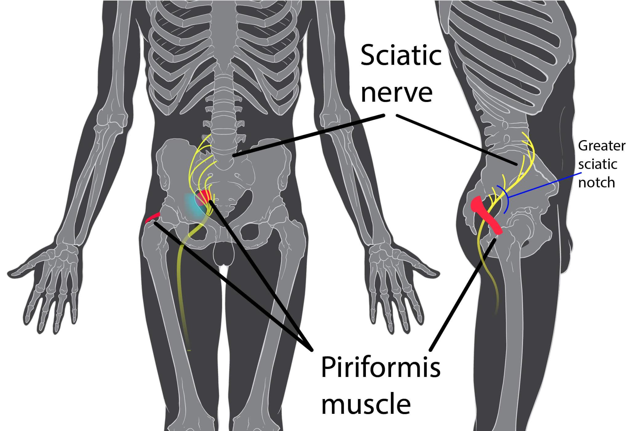 17. "Piriformis syndrome", 2022