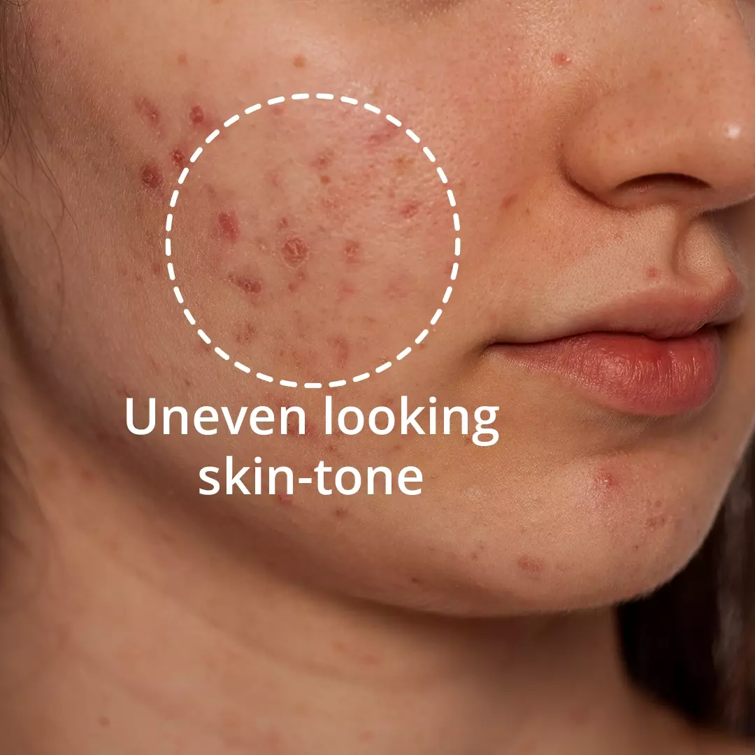 uneven looking skin-tone