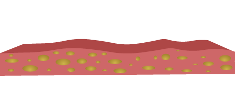 Third layer of skin - subcutaneous tisse