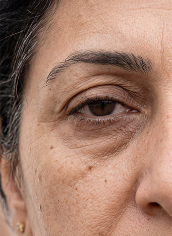 Dull, Dry, Puffy under eyes