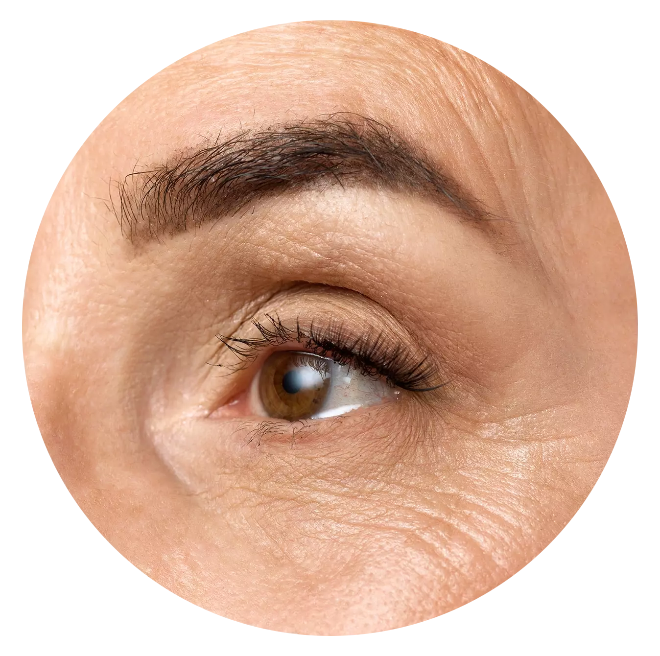 Crow's Feet and Eye Wrinkles