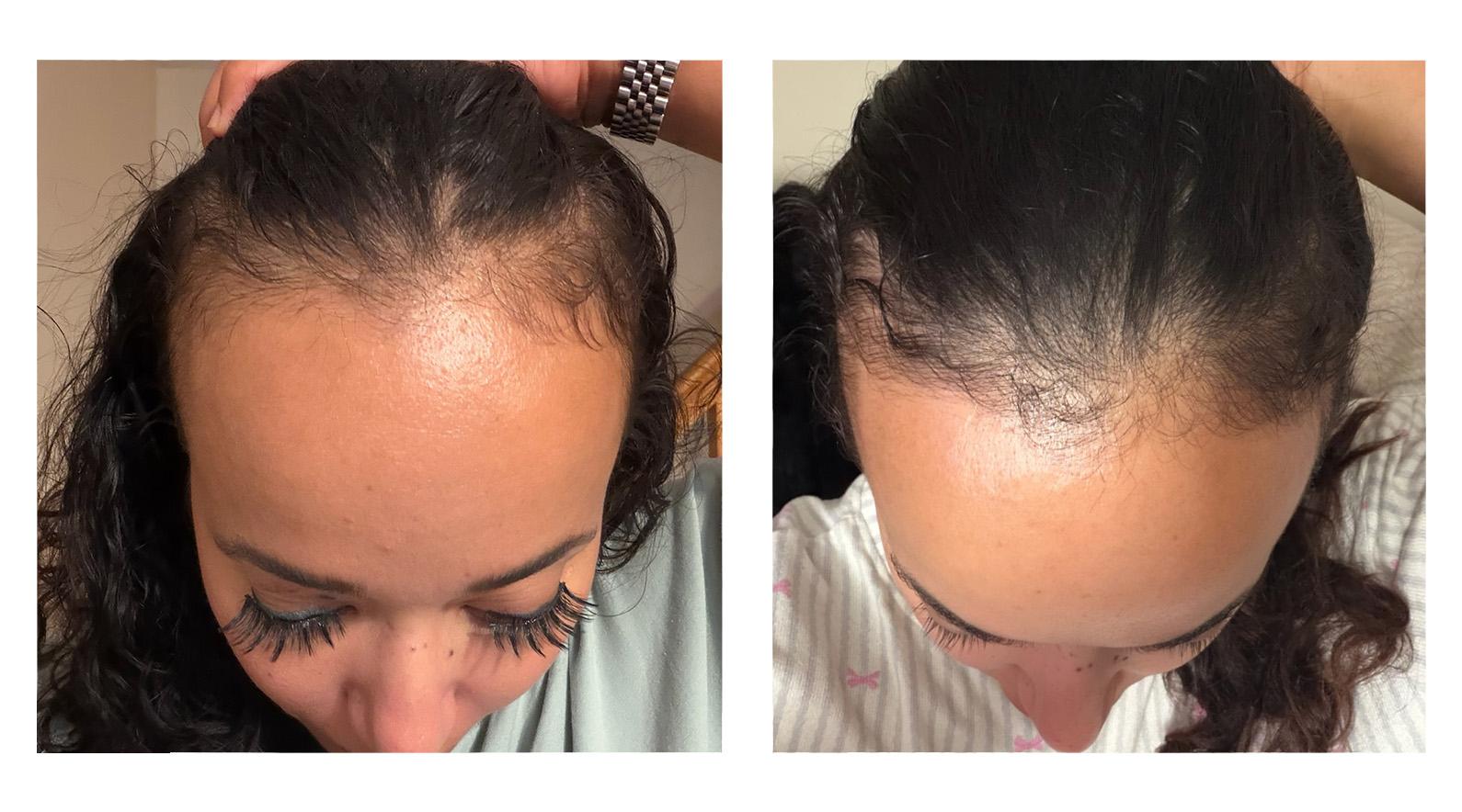 Rachel, after 3 months - front