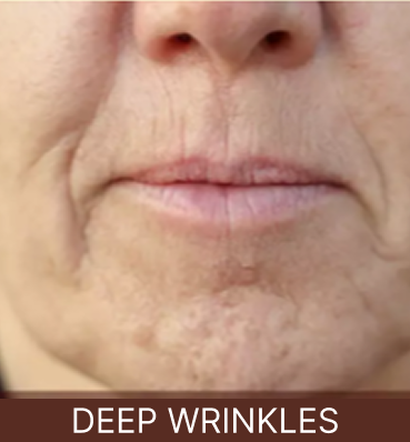 Deep Wrinkles - Tablet
