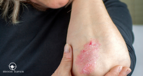 Download the Eczema & Psoriasis Natural Treatment Fact Sheet