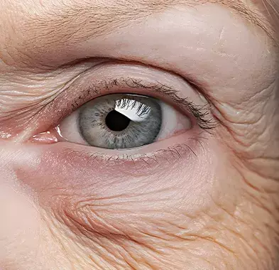 Puffiness