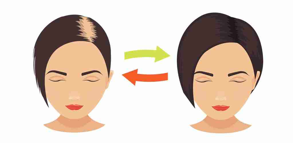 Women and the Battle with Hair Loss