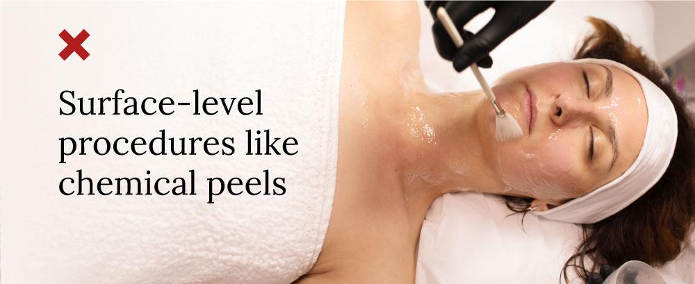 Surface-level procedures like chemical peels