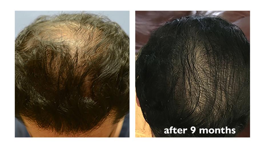 More Hair Naturally Before and After photos, Testimonials and reviews