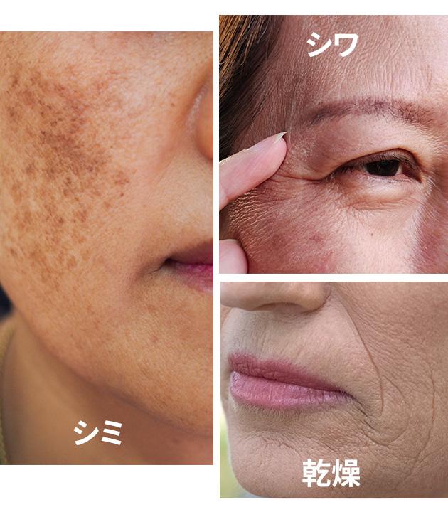 Age Spots, Wrinkles, Dryness