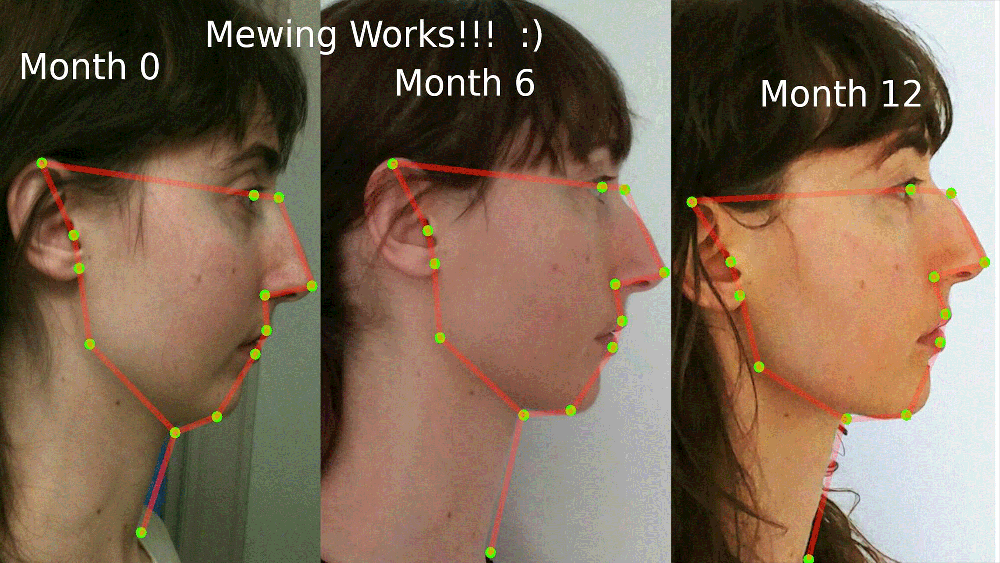 Surgery or mewing exercises. Result of a jawline reshape. Stock