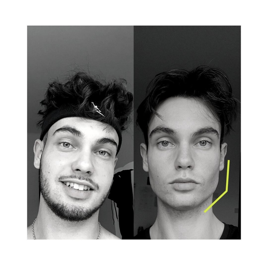 jawliner before and after