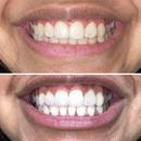 Polar MD teeth whitening