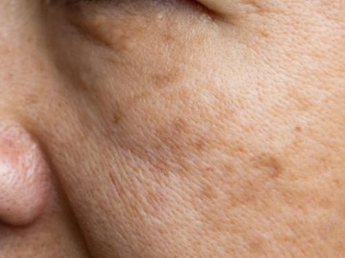 close-up of dark spots around woman's mouth and nose.