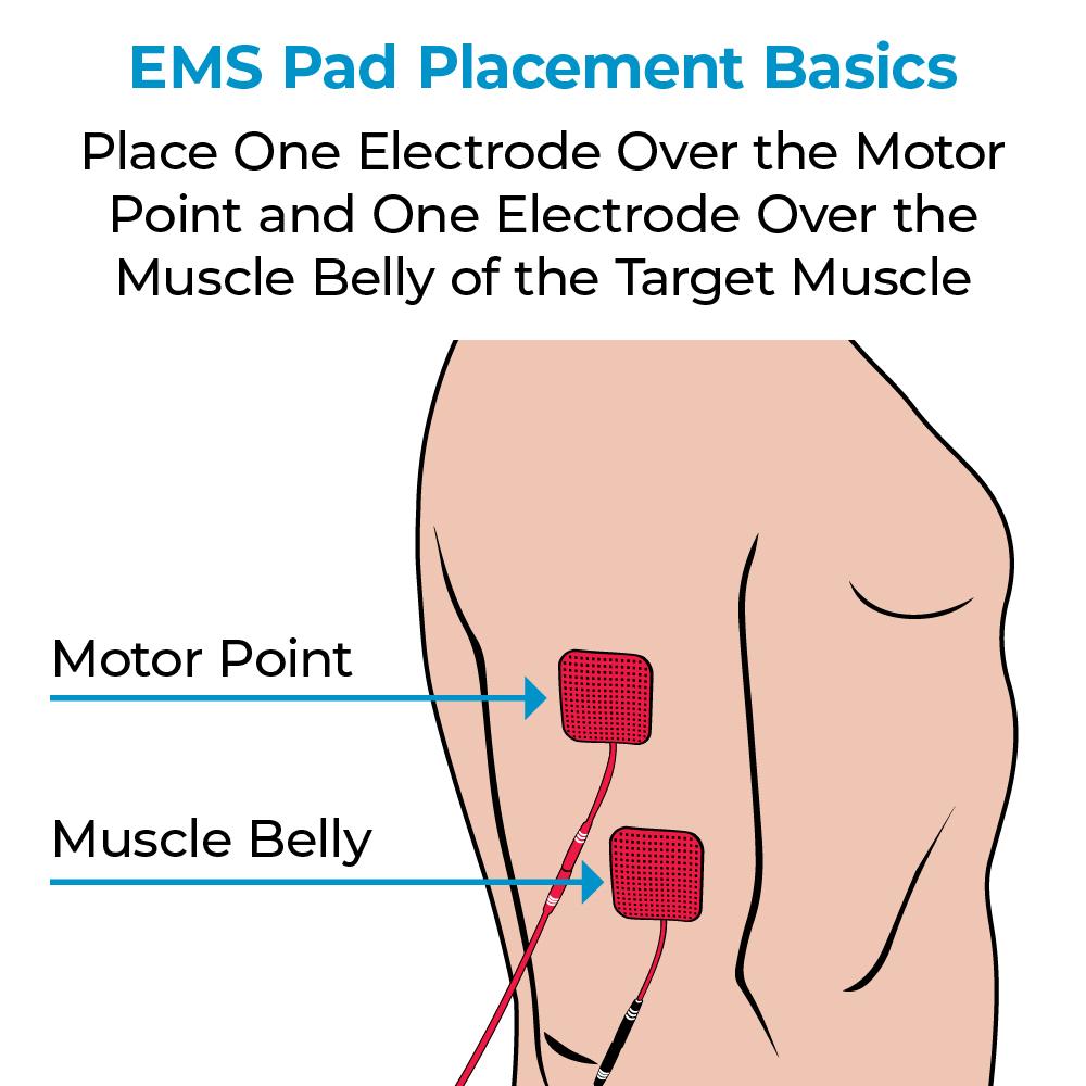 An illustration of electrodes on an arm muscle