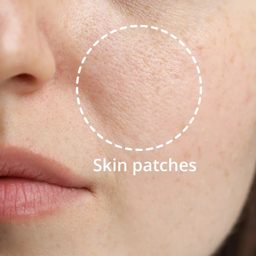 skin patches