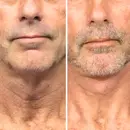 before after image of male in his 50's showing improved appearance of turkey neck