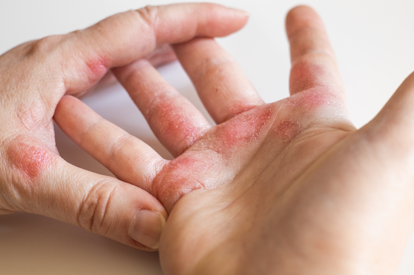 how do you cure eczema