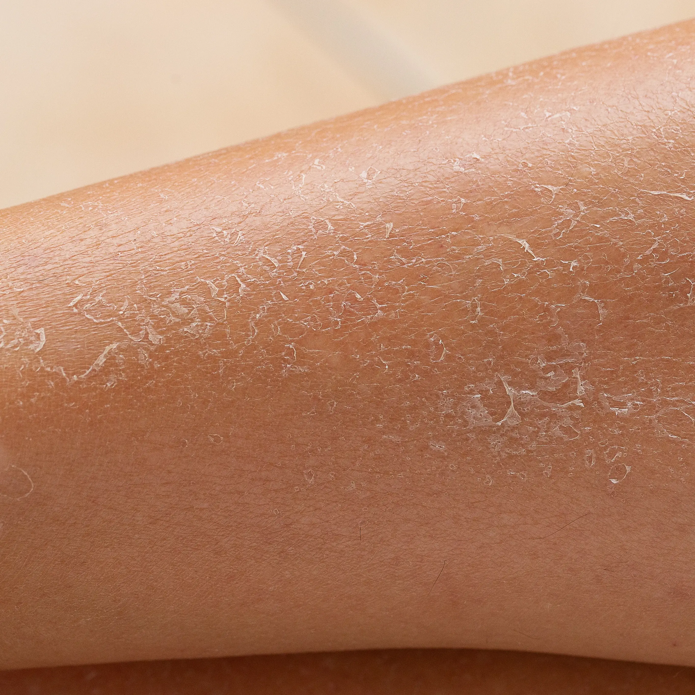 dry and itchy shins