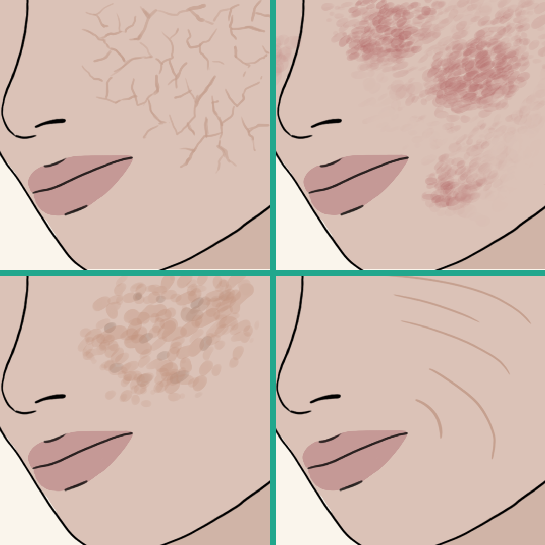 Illustration of face close up with dryness, dryness-triggered sensitivity, uneven skin-tone & signs of aging