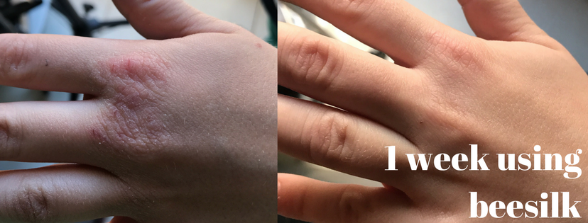 dry cracked skin before and after beesilk