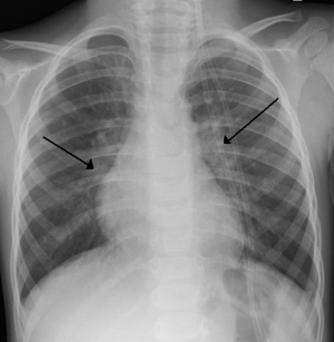 X-ray of a person's chest showing signs of pneumonia or lung distress, used to illustrate the potential severe health dangers and respiratory risks associated with sensitive users smoking with cold ice.