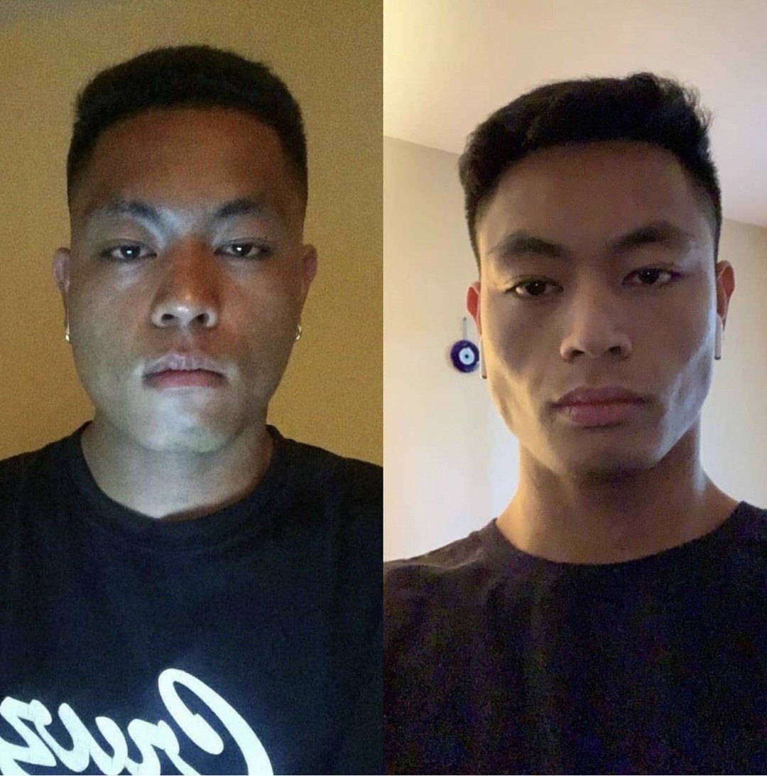 jawline before and after